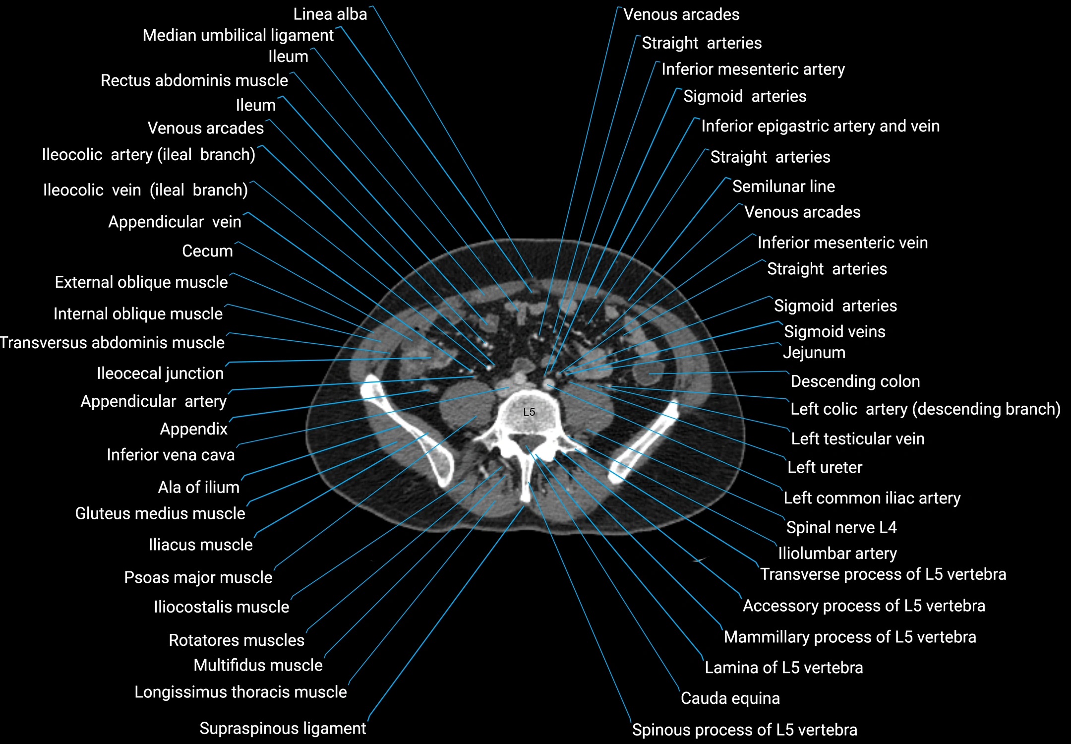 CT male pelvis axial cross sectional anatomy labelled radiology image -00124.webp